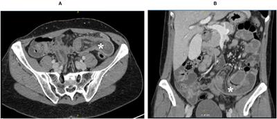 Case Report: Ileo-Ileal Intussusception Secondary to Inflammatory Fibroid Polyp: A Rare Cause of Intestinal Obstruction